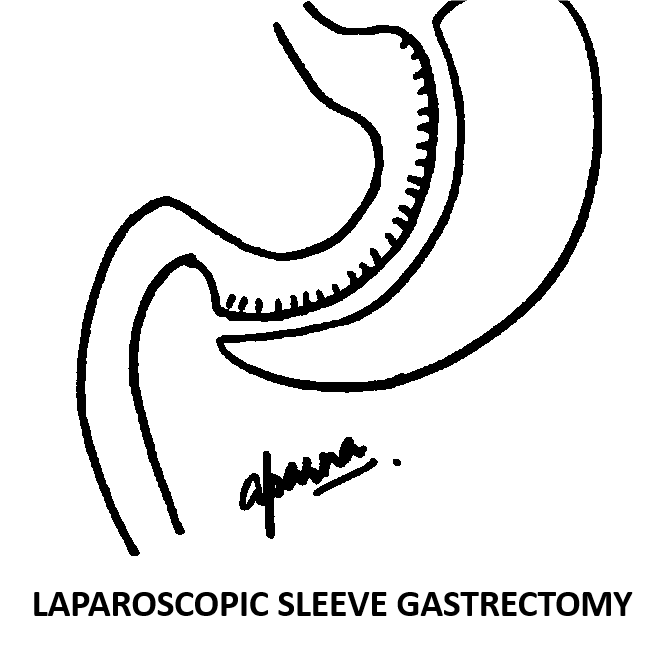 Gastric Sleeve Surgery, Laparoscopic Sleeve Gastrectomy Surgery in mumbai, india