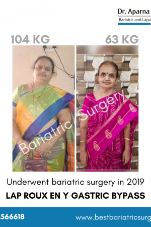bariatric surgery for weight loss before after photos in mumbai, india (1)