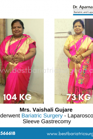 bariatric surgery for weight loss before after photos in mumbai, india (3)