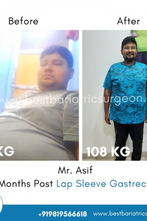 bariatric surgery for weight loss before after photos in mumbai, india