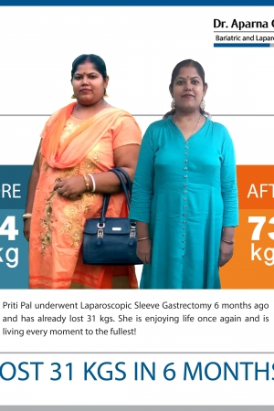 best bariatric surgery and weight loss surgery cost in mumbai india before after photos (5)