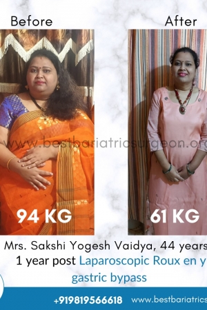 best bariatric surgery for weight loss before after photos in mumbai, india