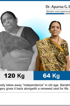 best intragastric balloon bariatric surgery and weight loss surgery in mumbai india before after photos (1)-min