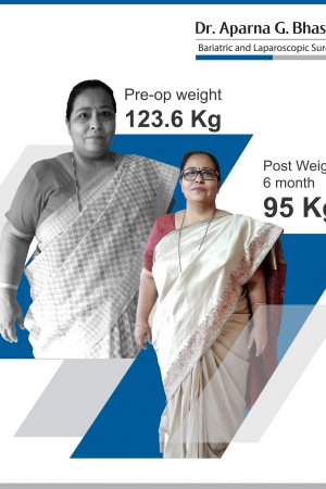 best intragastric balloon bariatric surgery and weight loss surgery in mumbai india before after photos (2)-min