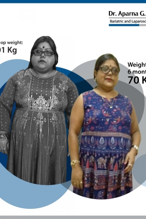 best intragastric balloon bariatric surgery and weight loss surgery in mumbai india before after photos (9)-min