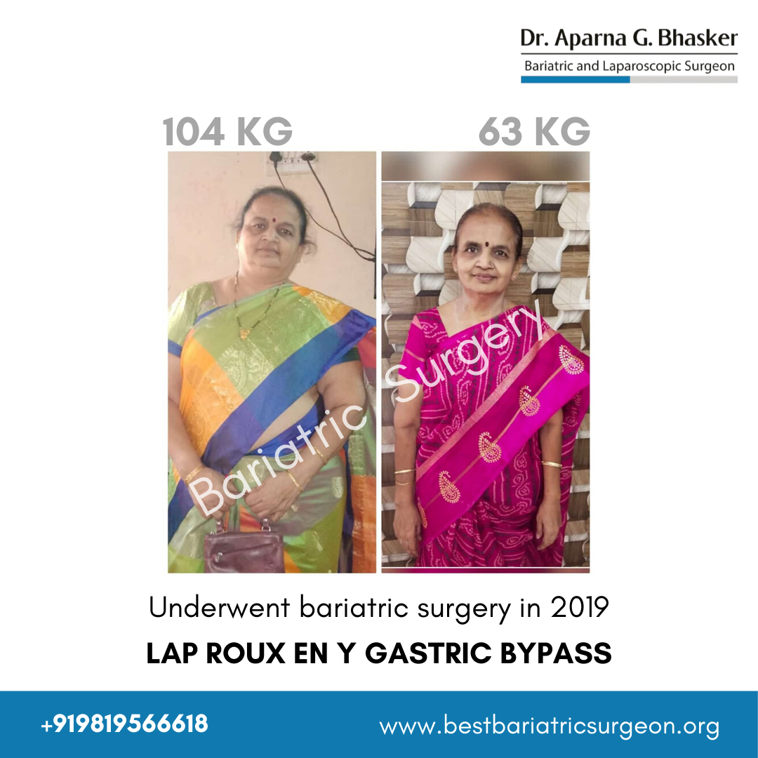 bariatric surgery for weight loss before after photos in mumbai, india (1)