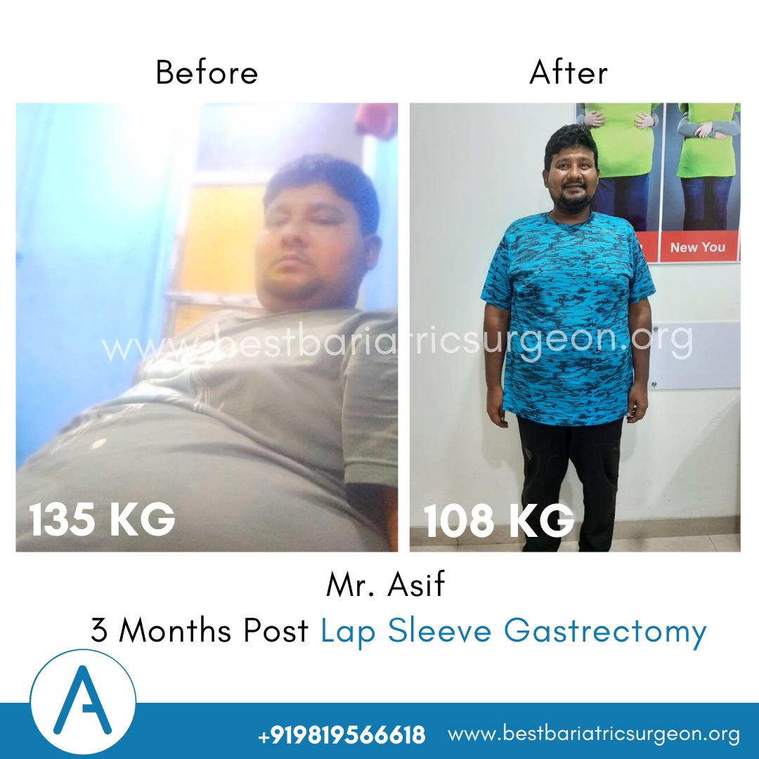 bariatric surgery for weight loss before after photos in mumbai, india
