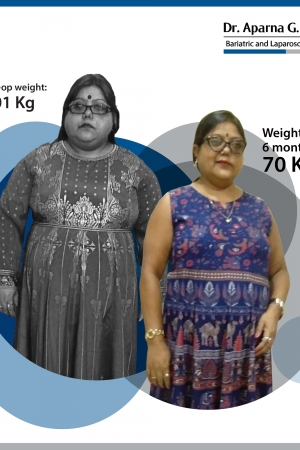 best Banded Roux-en Y Gastric Bypass bariatric surgery and weight loss surgery cost in mumbai india before after photos (9)