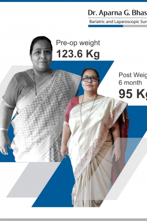best Gastric Banding bariatric surgery and weight loss surgery cost in mumbai india before after photos (2)