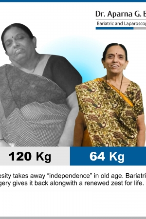 best Mini Gastric Bypass bariatric surgery and weight loss surgery cost in mumbai india before after photos (1)