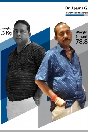 best Gastric Sleeve, Sleeve Gastronomy bariatric surgery and weight loss surgery cost in mumbai india before after photos (8)