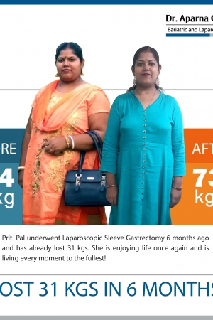 best Sleeve Gastrectomy with Duodeno Ileostomy bariatric surgery and weight loss surgery cost in mumbai india before after photos (5)