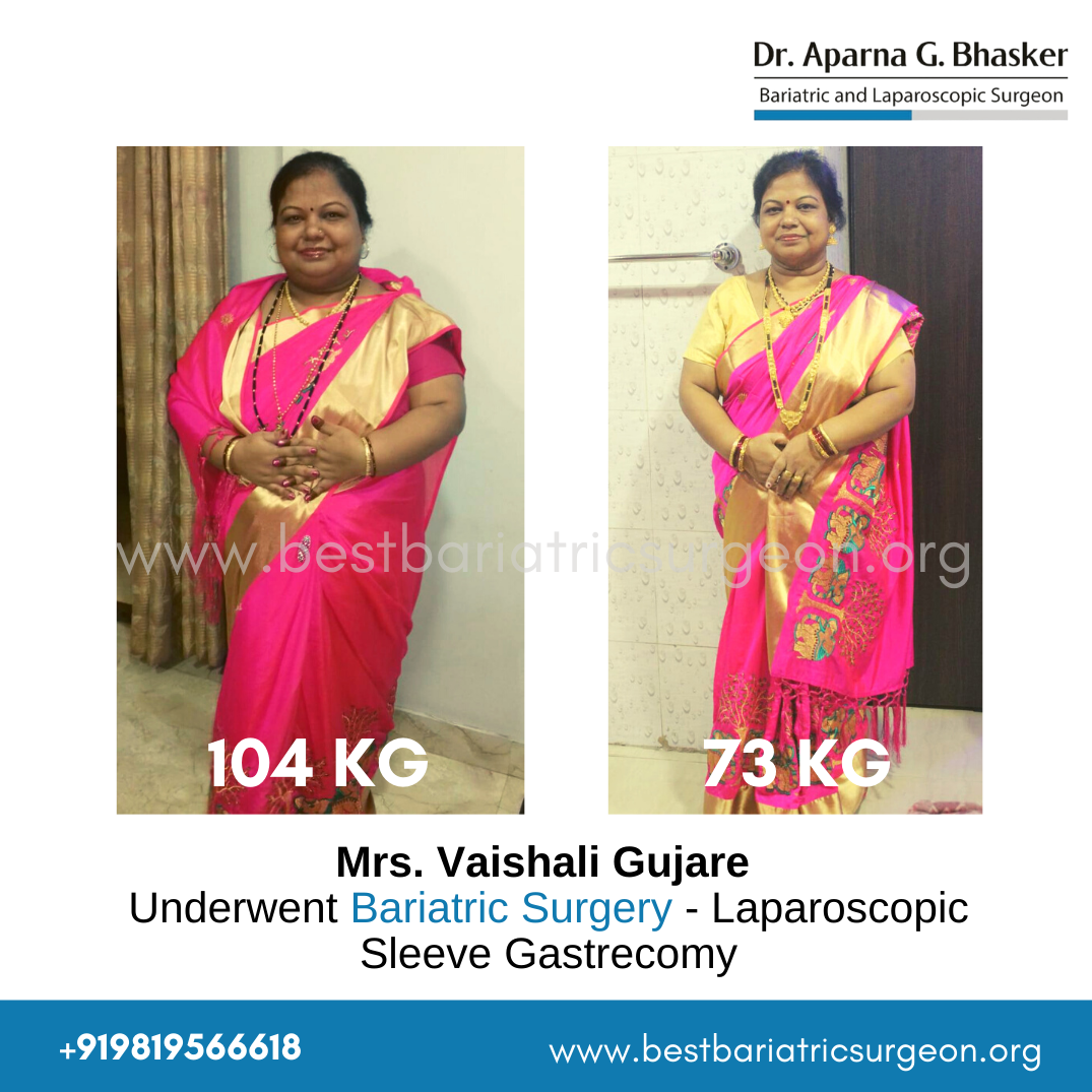 bariatric surgery for weight loss before after photos in mumbai, india (3)