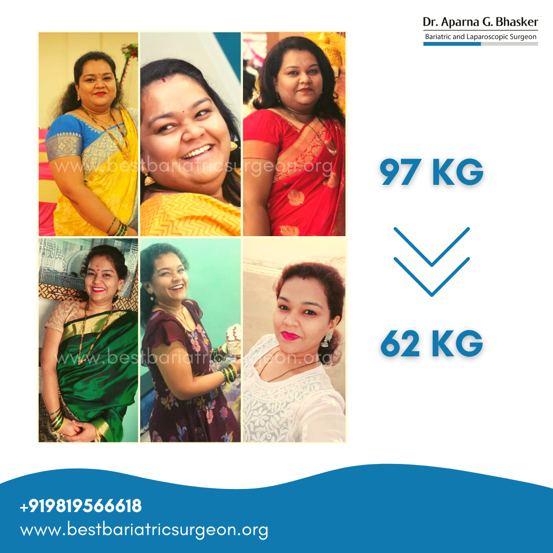bariatric surgery for weight loss before after photos in mumbai, india (2)