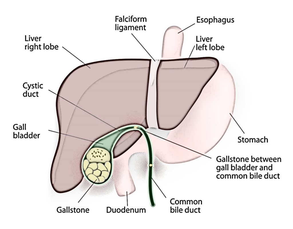 Laparoscopic Cholecystectomy Or Laparoscopic Gallbladder Stone Removal Surgery Or Laparoscopic Gallbladder Surgery in Mumbai, India