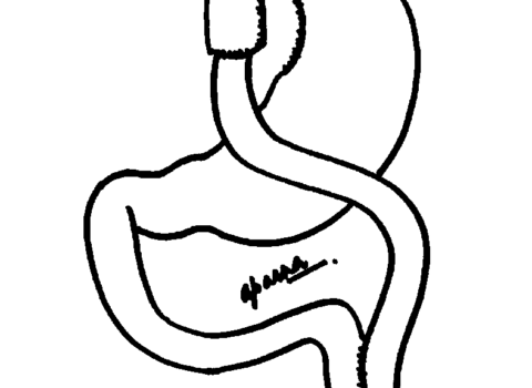 Laparoscopic Roux en-y gastric bypass Surgery in Mumbai, India by Dr. Aparna Govil Bhasker