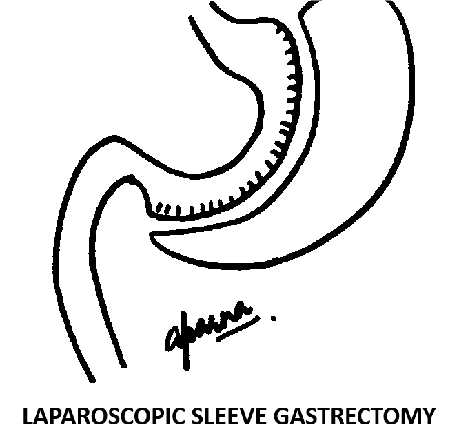 Laparoscopic Sleeve Gastrectomy Surgery in Mumbai, India by Dr. Aparna Govil Bhasker