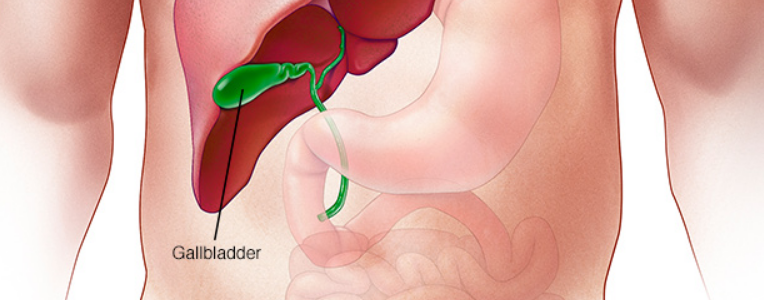 Gallbladder Removal, Gall Stone Surgery, Laparoscopic Cholecystectomy in Mumbai, India by Aparna Govil Bhasker