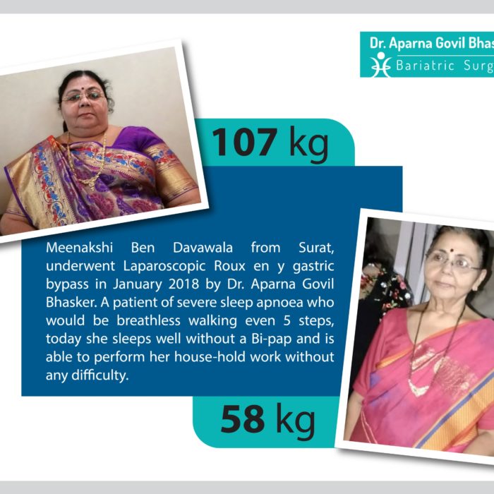 Best Bariatric Surgery Before After Photos, Weight Loss Surgery, Cost in Mumbai, India by Dr Aparna Govil Bhasker