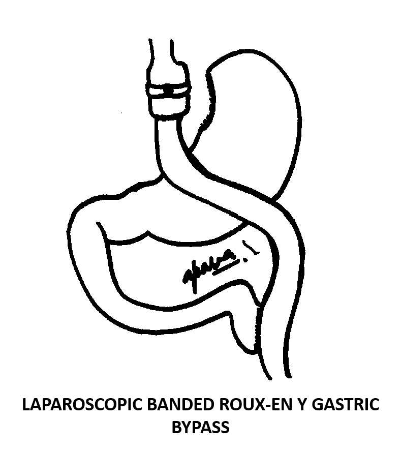 Roux-en y gastric bypass surgery in mumbai, india