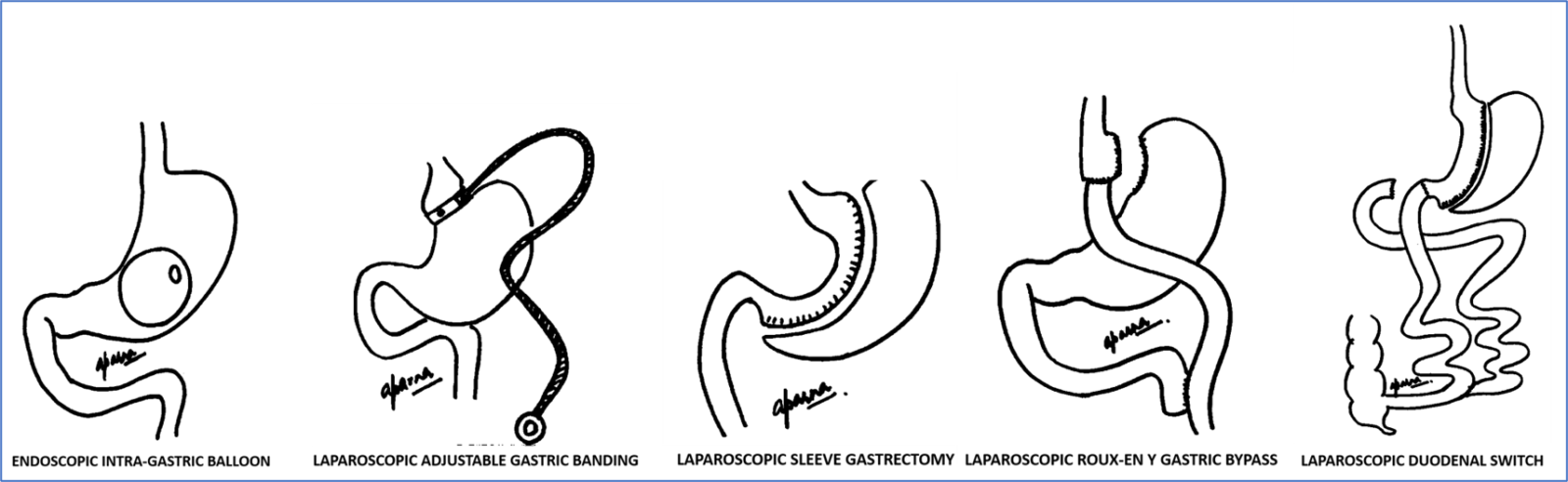 type of bariatric surgery in mumbai, india