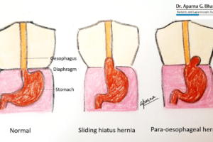 Hiatal Hernia Surgery - Are You Considering Surgery to End Your Heartburn?