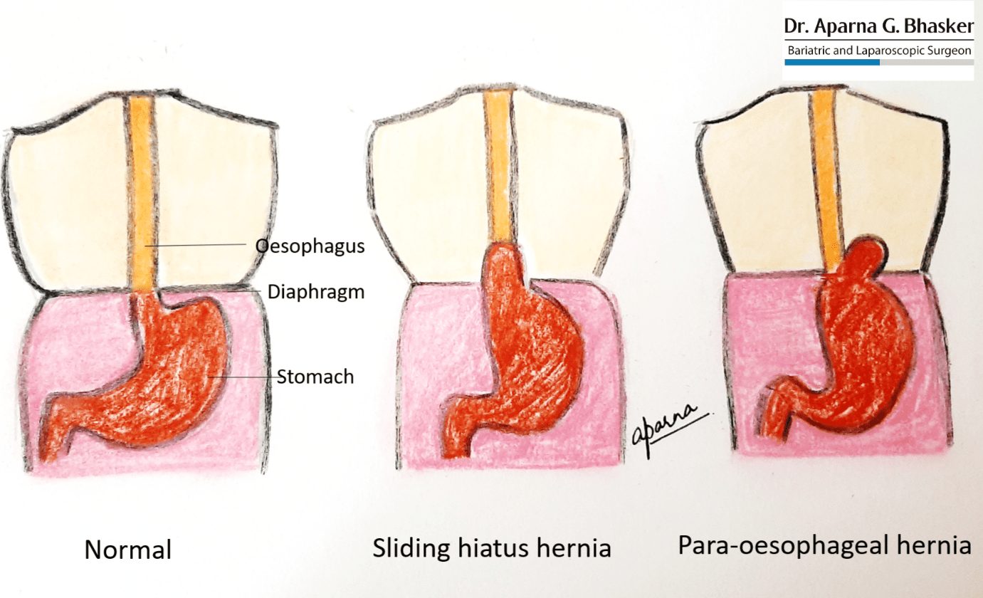 Stomach Hernia Surgery pin-on-health-notes