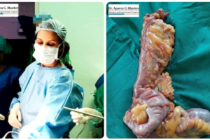 A Rare Case Of Non Hodgkins Lymphoma Of Appendix And Ileum