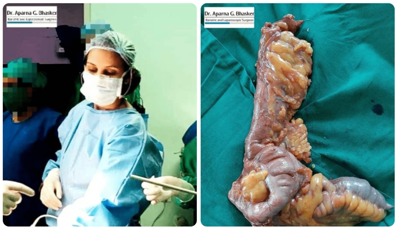 A Rare Case Of Non Hodgkins Lymphoma Of Appendix And Ileum