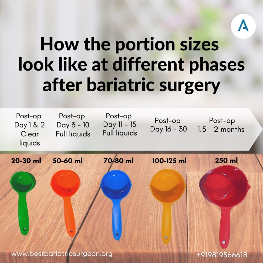More To Know About Before And After Bariatric Surgery