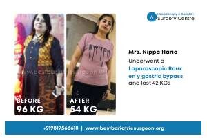 Patient Result of Bariatric Surgery in Mumbai, india for Weight Loss- Dr Aparna Govil Bhasker