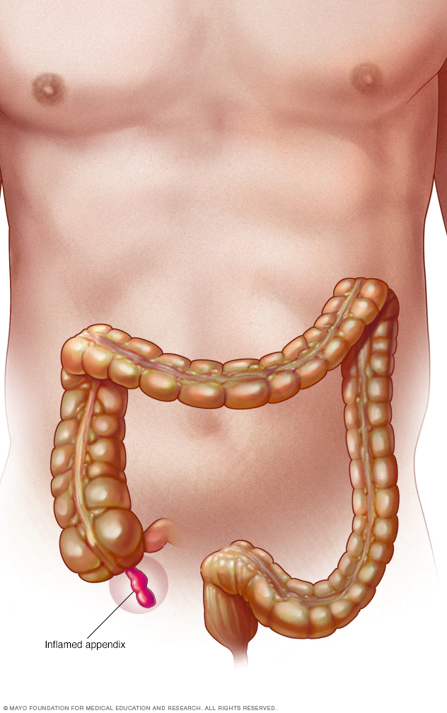 Appendix Surgery in Mumbai, Best Appendix Removal Operation Cost india