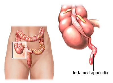 Best Appendix Surgery in Mumbai, Best Appendix Removal Operation Cost in india