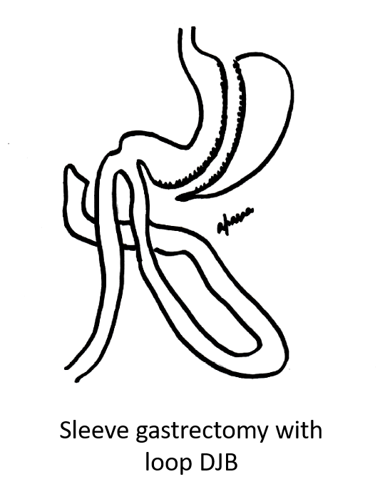 laparoscopic-sleeve-gastrectomy-with-duodeno-jejunostomy-surgery-in-mumbai