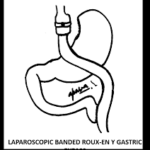 laparoscopic-banded-roux-en-y-gastric-bypass 