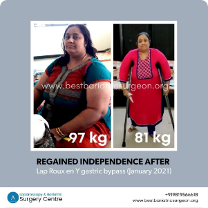 Weight-Loss-Surgery Result