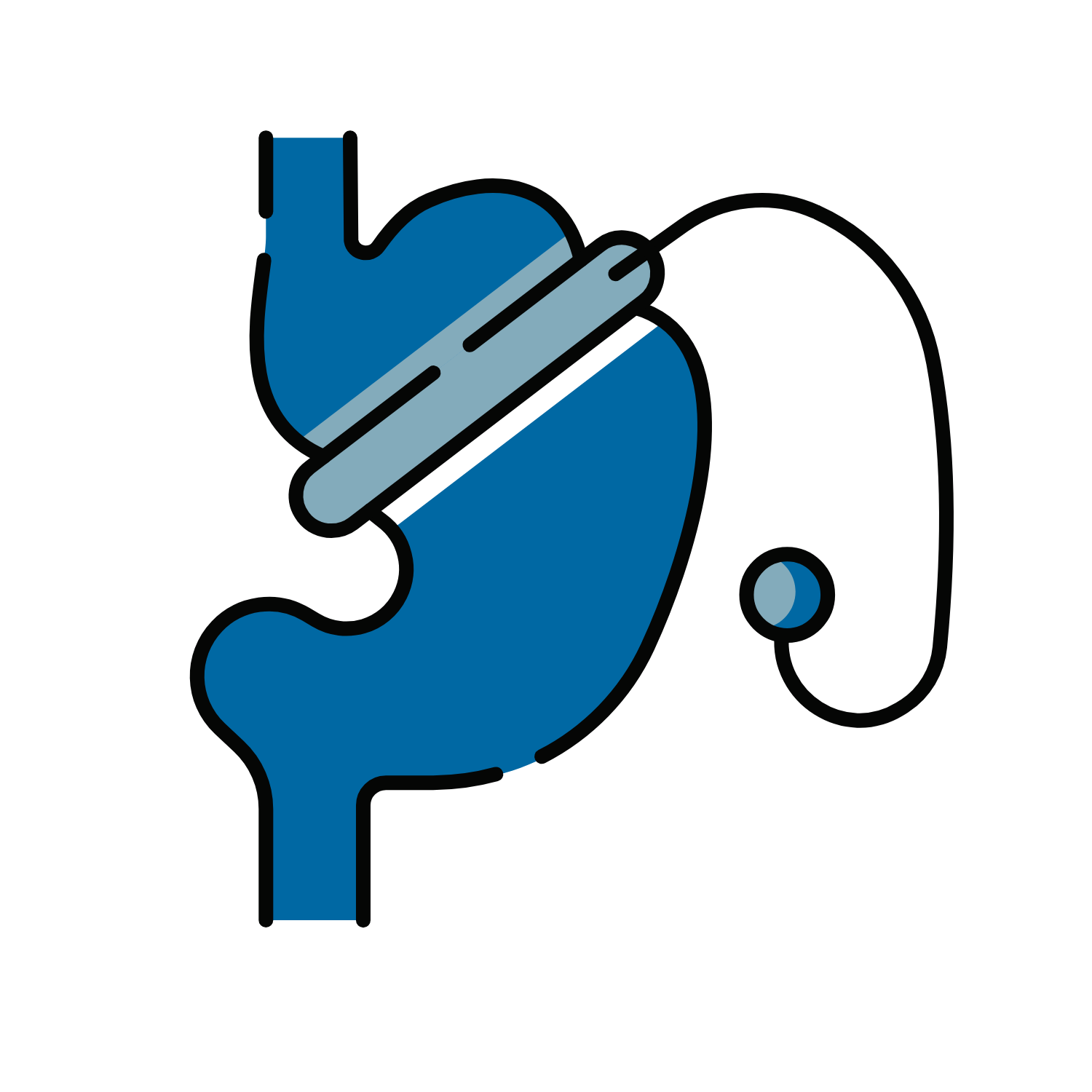 Best-Laparoscopic-Adjustable-Gastric-Banding-Surgery