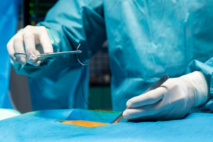 gastric sleeve laparoscopic surgery