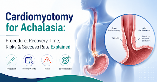 Cardiomyotomy for Achalasia Procedure Cardiomyotomy for Achalasia: Procedure
